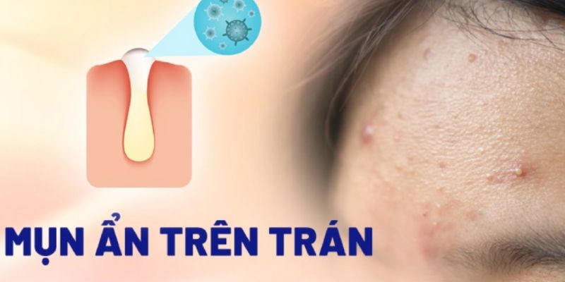 Vị trí mụn ẩn trên vùng trán